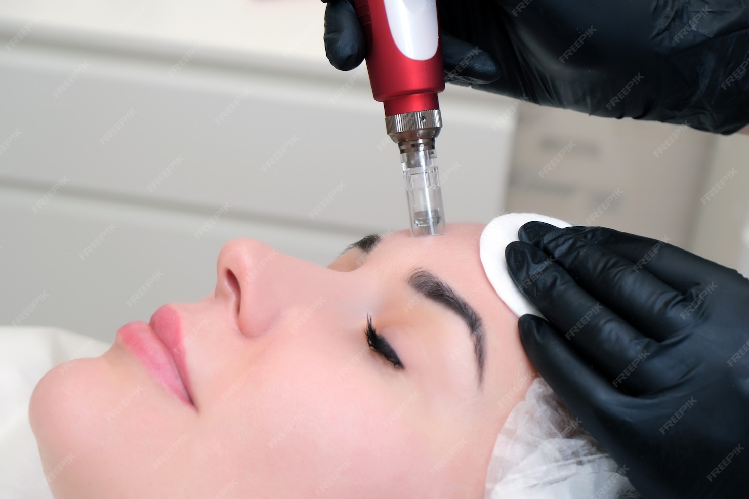 Facial rejuvenation treatments with microneedling in Mineola
